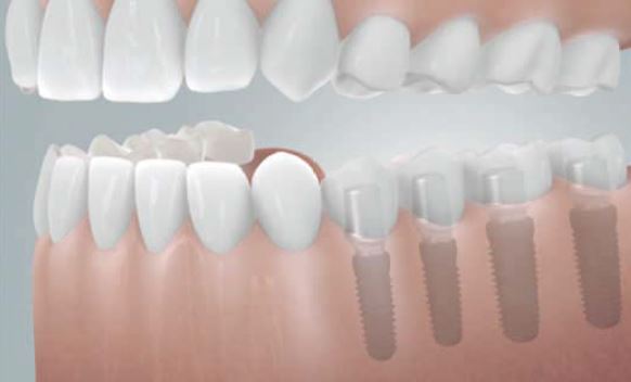 Grafik: Diese Freiendsituation (4 fehlende Zähne) wurde mit 4 Implantaten Zahn für Zahn geschlossen