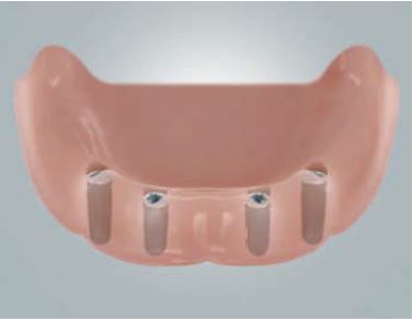 Grafik: Zahnloser Unterkiefer mit 4 Implantaten
